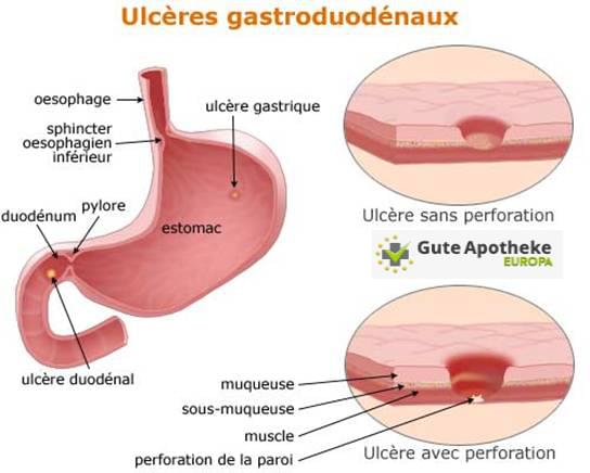 L’ulcère de l’estomac