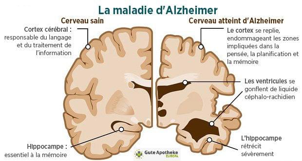 La maladie d'Alzheimer